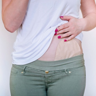 Leicht angehobenes Oberteil zeigt den Bauchbereich mit Stoma unter der Kleidung. 