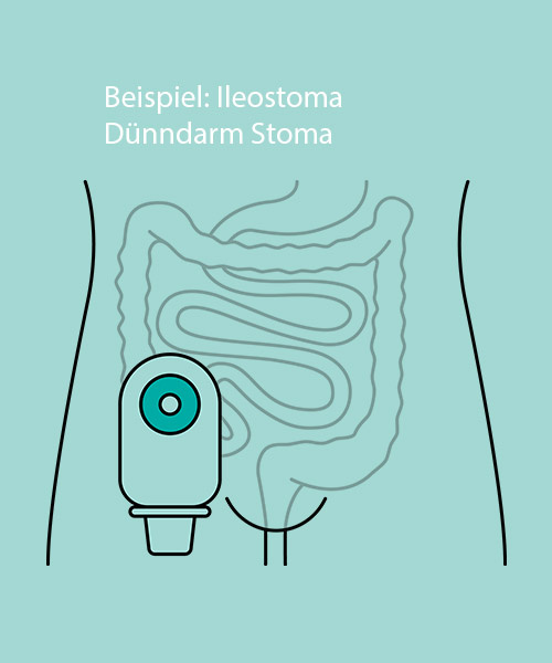 Was ist ein Stoma - PubliCare