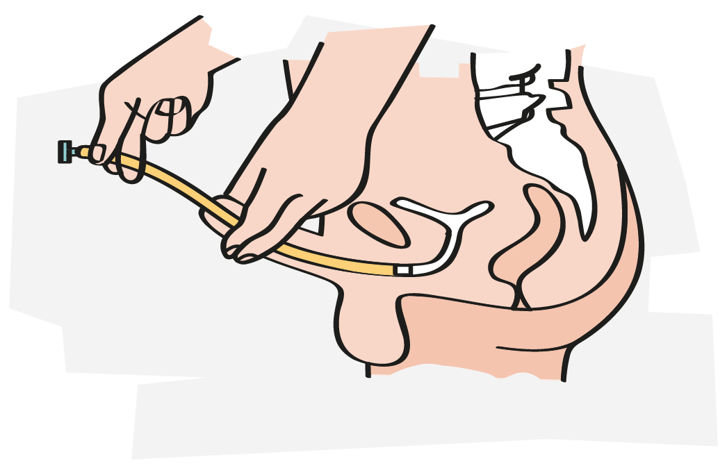 ISK -Intermittierender Selbstkatheterismus Anleitung Mann