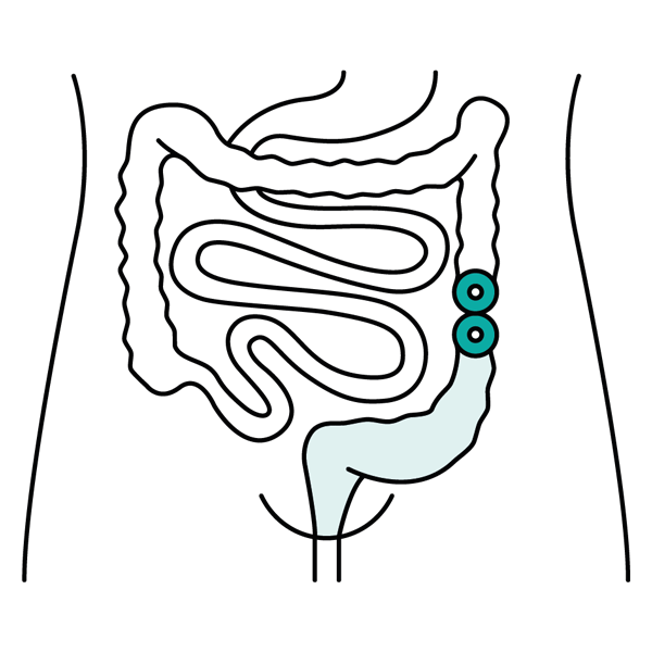 Colostoma Stoma Arten PubliCare