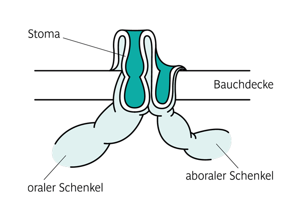 doppelläufiges Stoma