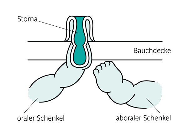 endständiges Stoma PubliCare